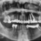 Inserarea Implanturilor Dentare / OPTISTUD