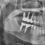 Inserarea implanturilor dentare